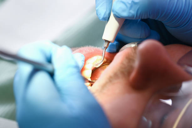 Best Knocked-Out Tooth (Avulsed Tooth) Treatment in Ewa Villages, HI